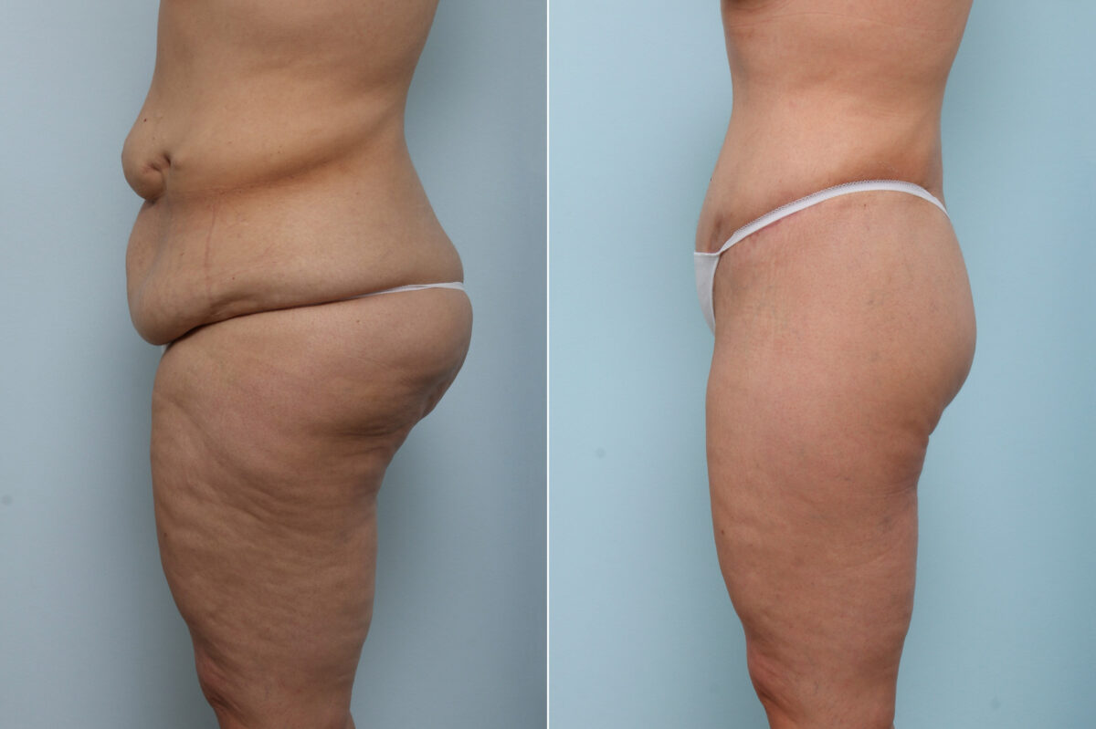 Body Lift before and after photos in Houston, TX, Patient 59956