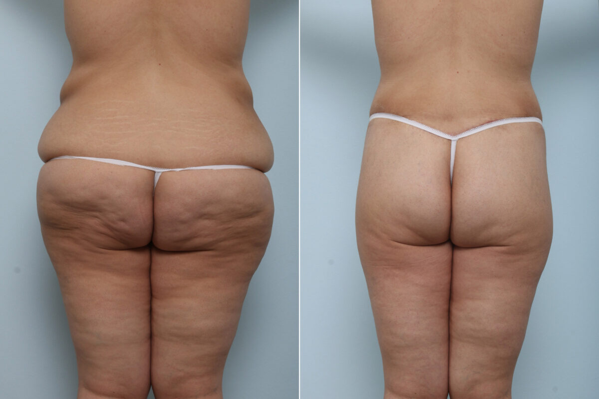 Body Lift before and after photos in Houston, TX, Patient 59956