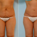 Abdominoplasty before and after photos in Houston, TX, Patient 24269