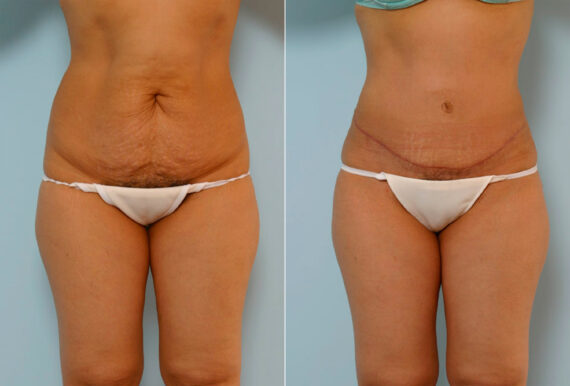 Tummy Tuck/Abdominoplasty before and after photos in Houston, TX, Patient 24269