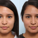 Non-Surgical Rhinoplasty before and after photos in Houston, TX, Patient 60050