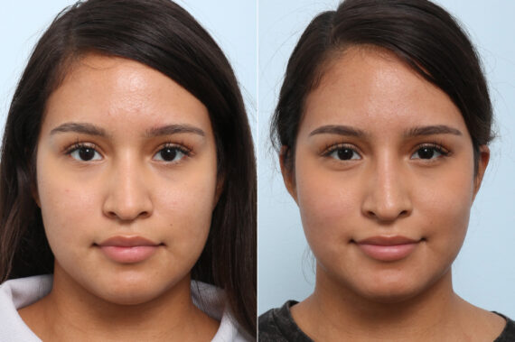 Non-Surgical Rhinoplasty before and after photos in Houston, TX, Patient 60050