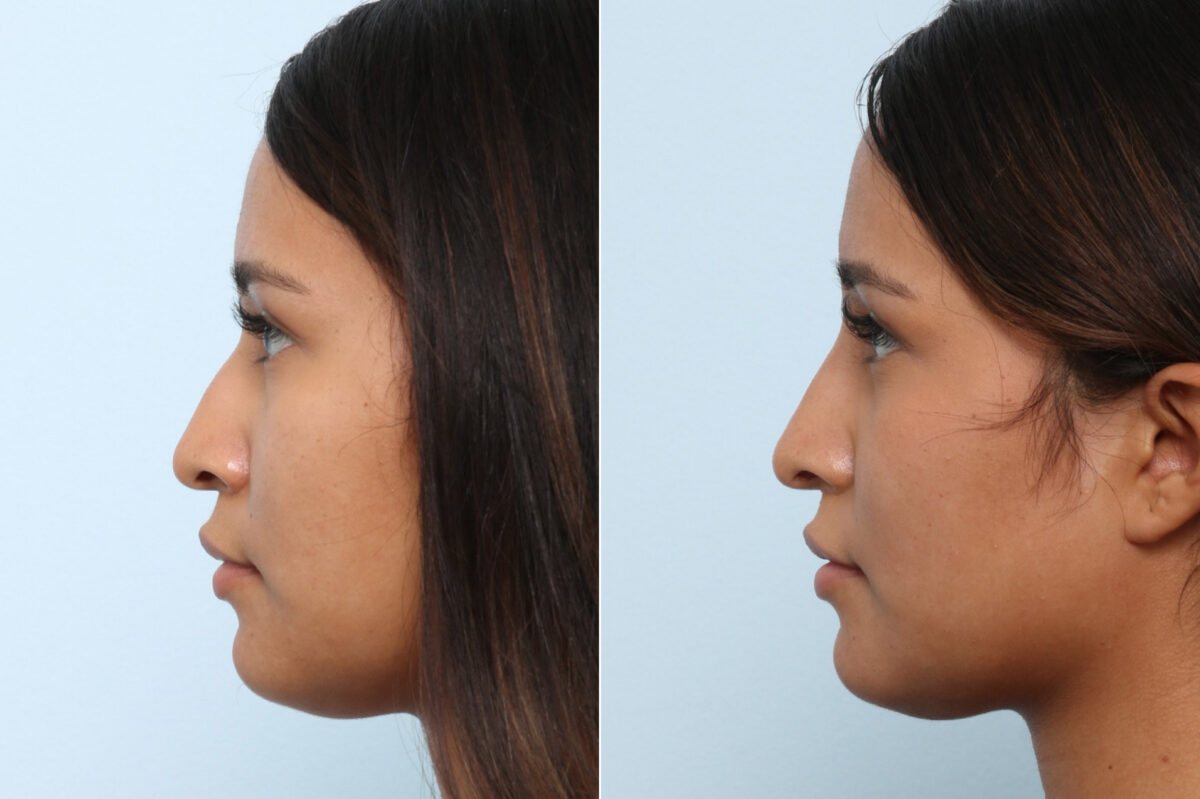 Non-Surgical Rhinoplasty before and after photos in Houston, TX, Patient 60050