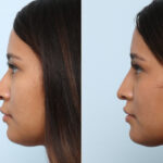 Non-Surgical Rhinoplasty before and after photos in Houston, TX, Patient 60050