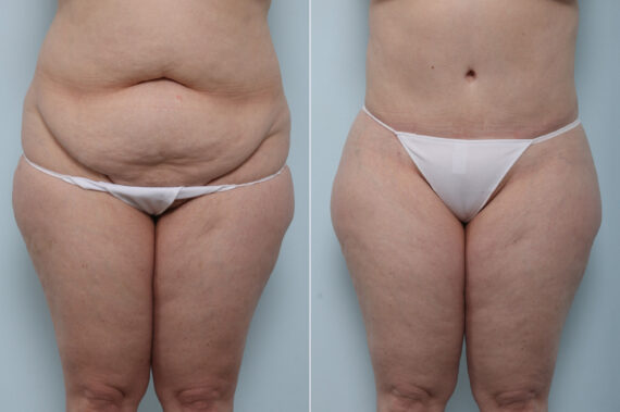 Body Lift before and after photos in Houston, TX, Patient 60091