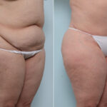 Body Lift before and after photos in Houston, TX, Patient 60091
