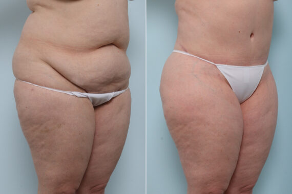 Body Lift before and after photos in Houston, TX, Patient 60091