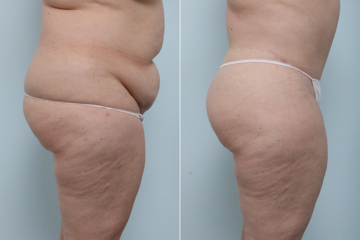 Body Lift before and after photos in Houston, TX, Patient 60091