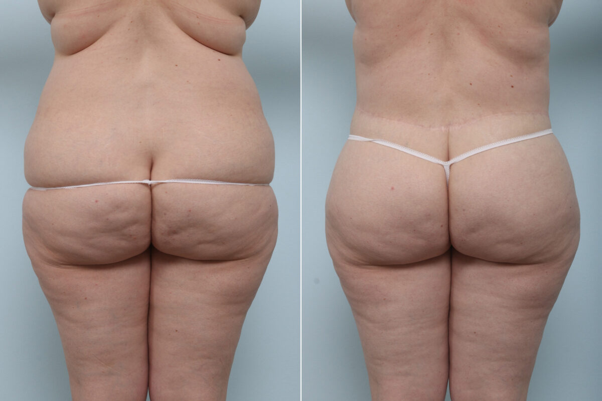 Body Lift before and after photos in Houston, TX, Patient 60091