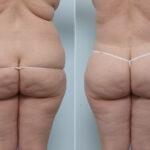 Body Lift before and after photos in Houston, TX, Patient 60091
