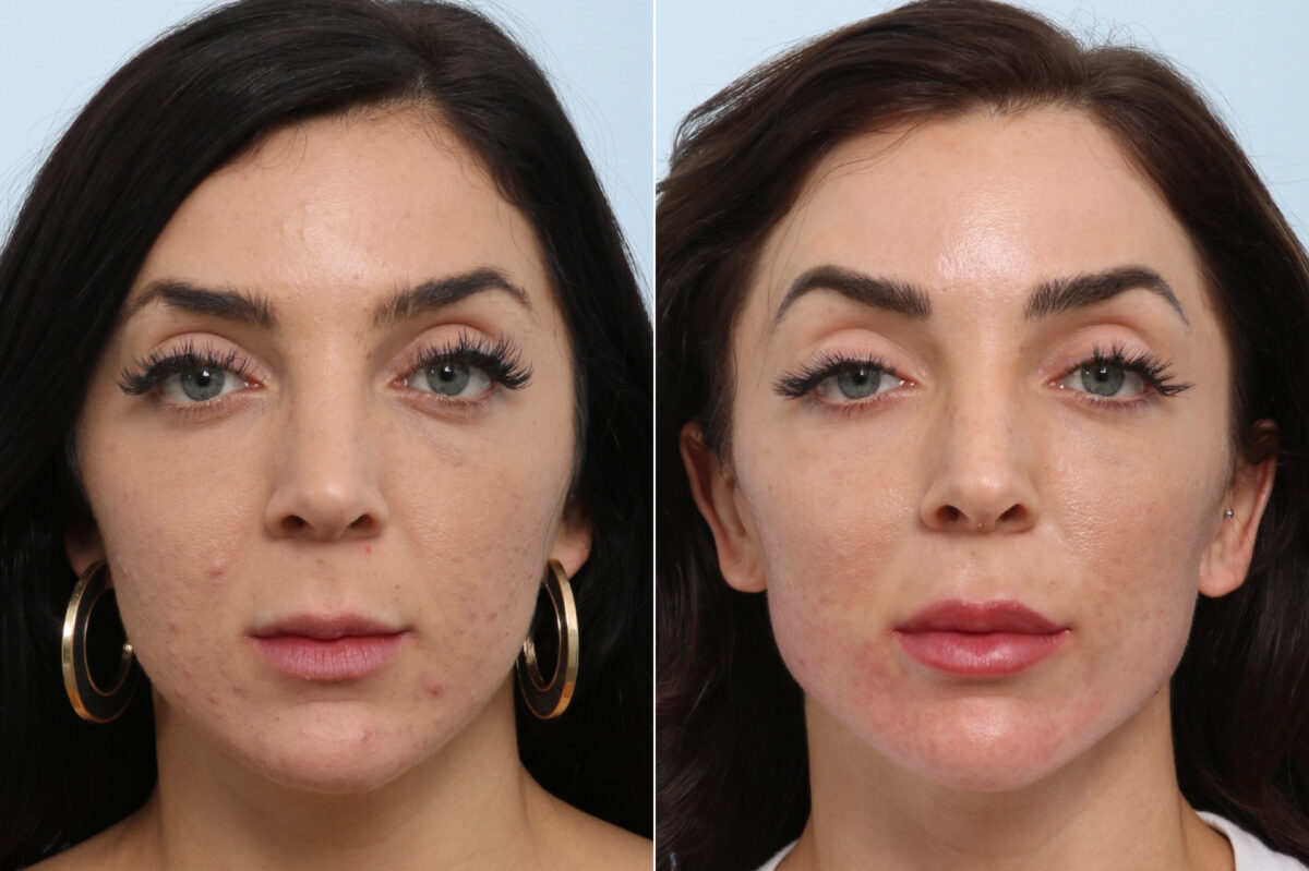 Radiesse before and after photos in Houston, TX, Patient 60058