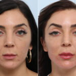 Radiesse before and after photos in Houston, TX, Patient 60058