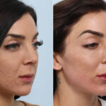 Radiesse before and after photos in Houston, TX, Patient 60058