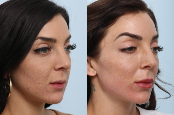 Radiesse before and after photos in Houston, TX, Patient 60058