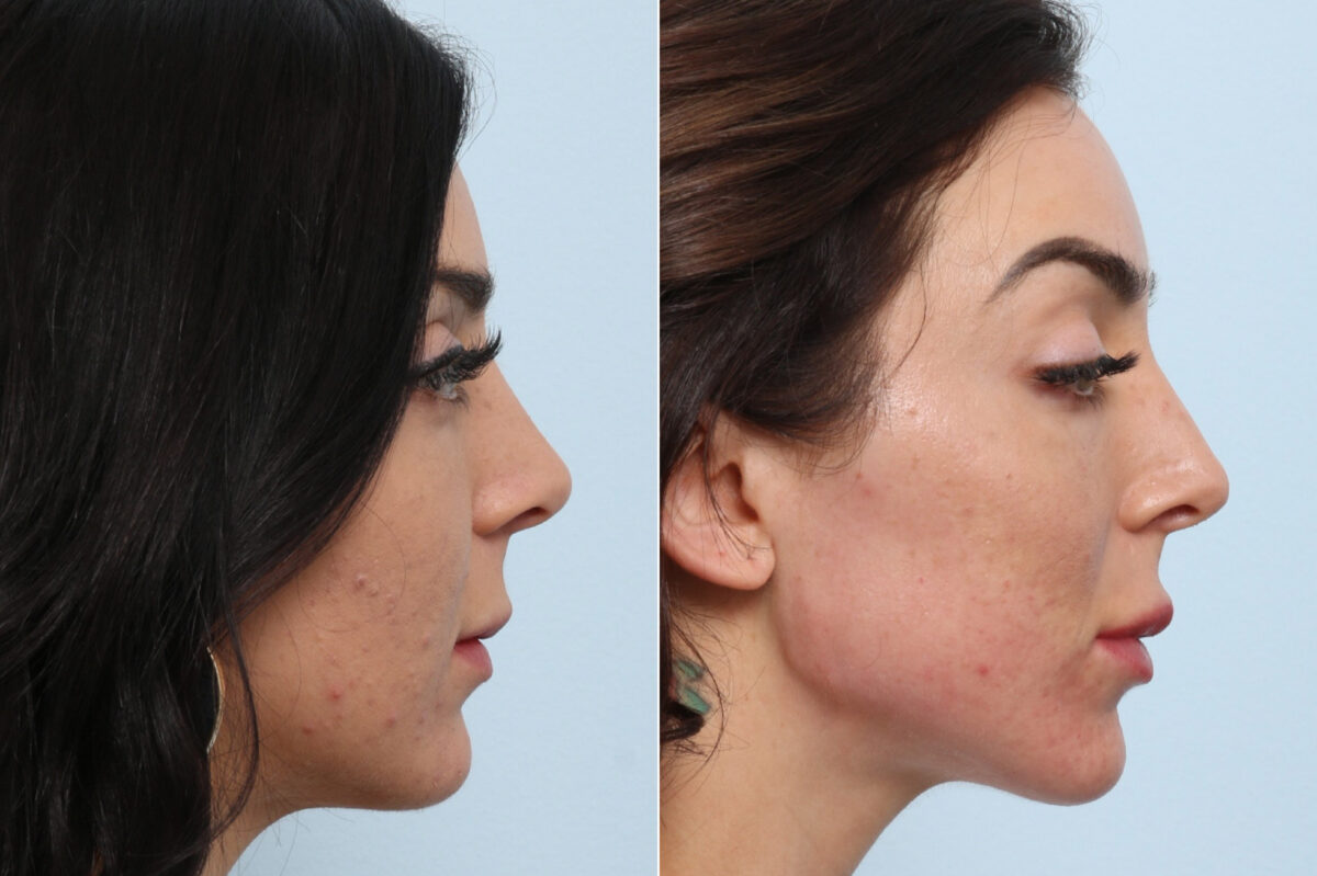 Radiesse before and after photos in Houston, TX, Patient 60058