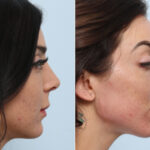 Radiesse before and after photos in Houston, TX, Patient 60058