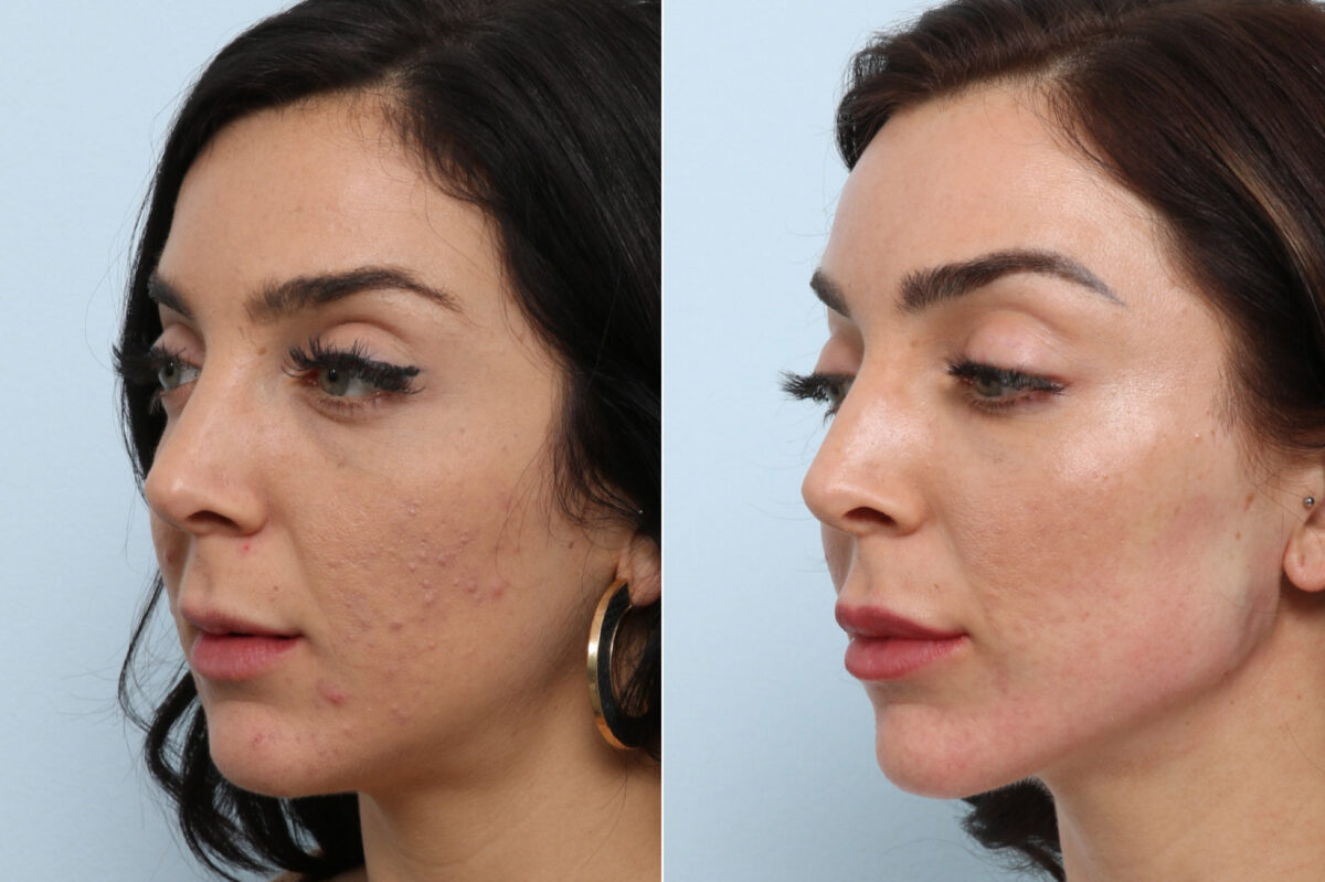 Radiesse before and after photos in Houston, TX, Patient 60058