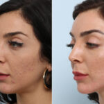 Radiesse before and after photos in Houston, TX, Patient 60058