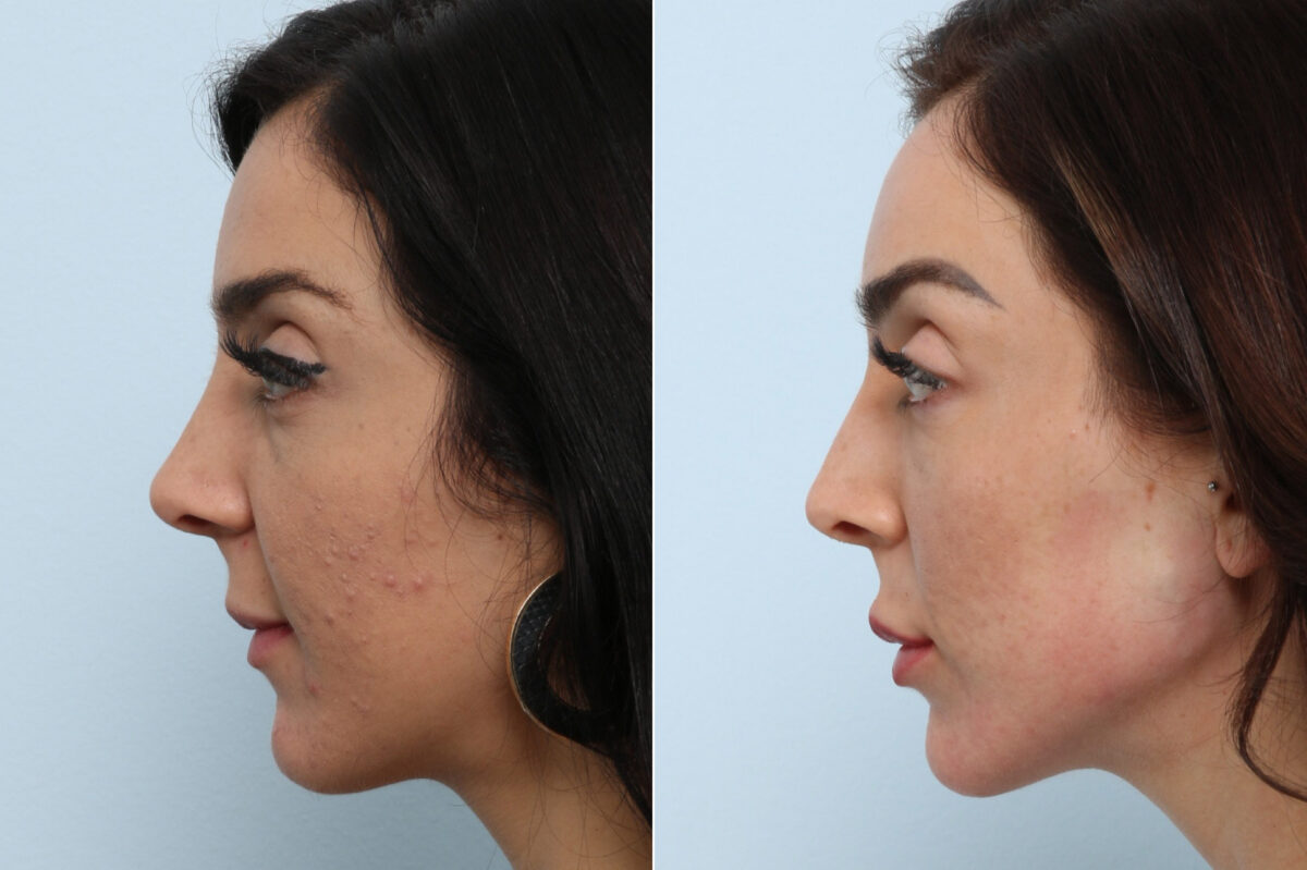 Radiesse before and after photos in Houston, TX, Patient 60058