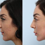 Radiesse before and after photos in Houston, TX, Patient 60058