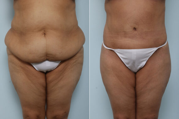 Body Lift before and after photos in Houston, TX, Patient 60156