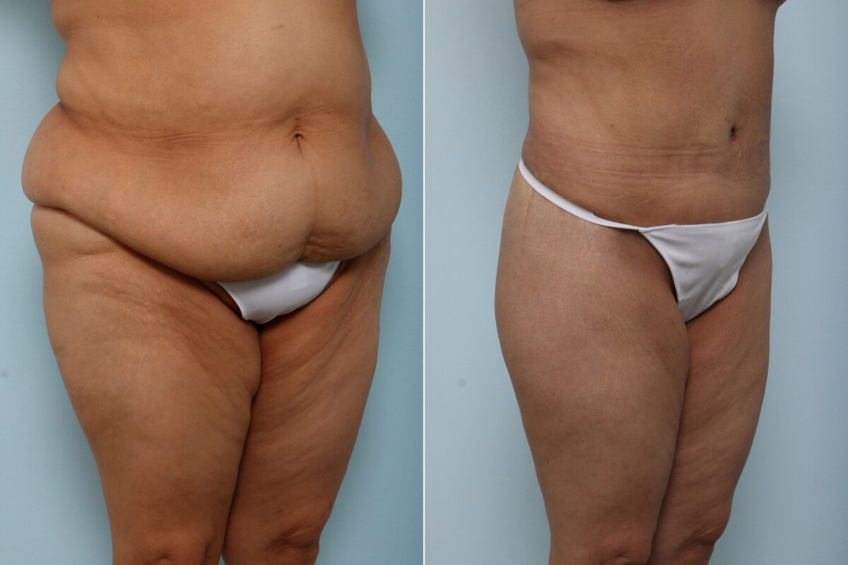 Body Lift before and after photos in Houston, TX, Patient 60156