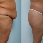 Body Lift before and after photos in Houston, TX, Patient 60156