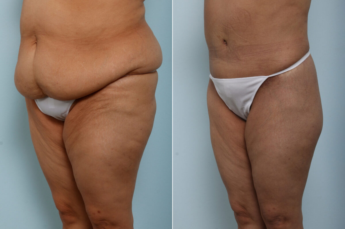 Body Lift before and after photos in Houston, TX, Patient 60156