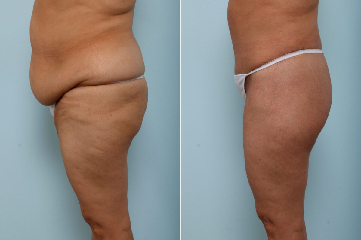 Body Lift before and after photos in Houston, TX, Patient 60156