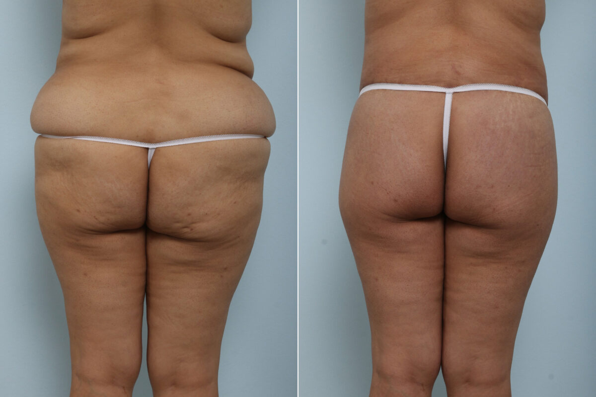 Body Lift before and after photos in Houston, TX, Patient 60156