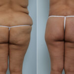 Body Lift before and after photos in Houston, TX, Patient 60156