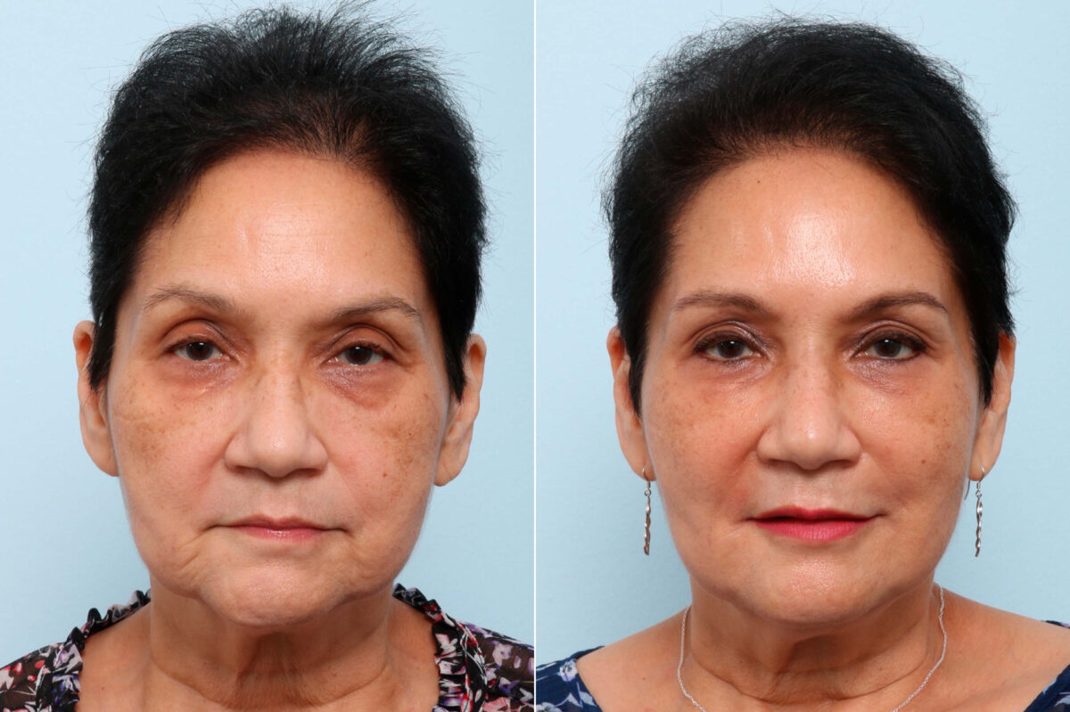 Fillers before and after photos in Houston, TX, Patient 60186