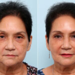 Fillers before and after photos in Houston, TX, Patient 60186