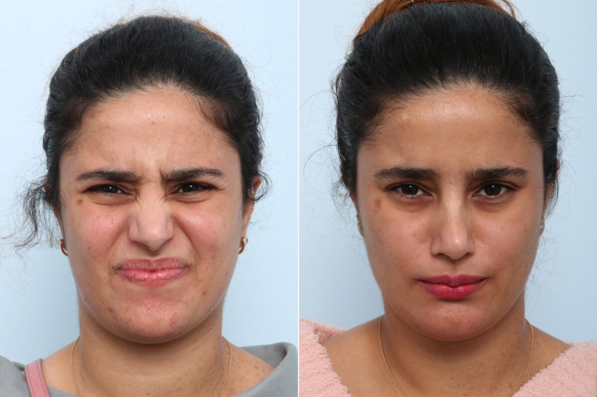 Xeomin / Botox® Cosmetic before and after photos in Houston, TX, Patient 60267