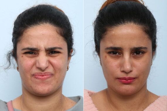 Xeomin / Botox® Cosmetic before and after photos in Houston, TX, Patient 60267