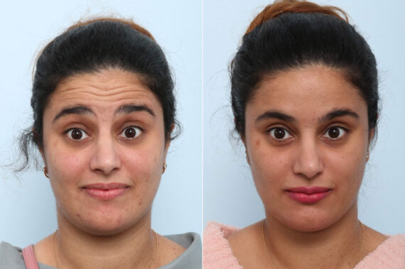 Xeomin / Botox® Cosmetic before and after photos in Houston, TX, Patient 60267