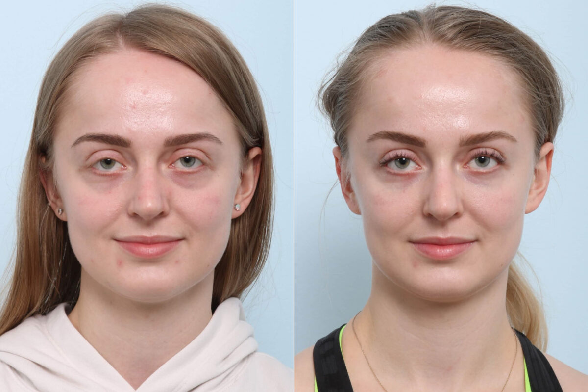 Xeomin / Botox® Cosmetic before and after photos in Houston, TX, Patient 60284