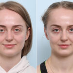 Botox® Cosmetic before and after photos in Houston, TX, Patient 60284