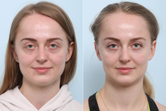 Xeomin / Botox® Cosmetic before and after photos in Houston, TX, Patient 60284