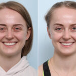 Botox® Cosmetic before and after photos in Houston, TX, Patient 60284