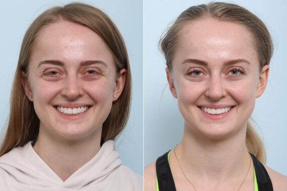 Botox® Cosmetic before and after photos in Houston, TX, Patient 60284