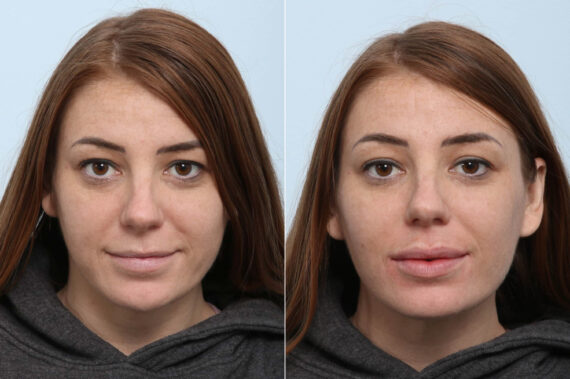 Lip Augmentation before and after photos in Houston, TX, Patient 60317