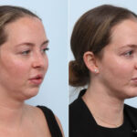 Chin Augmentation before and after photos in Houston, TX, Patient 60304