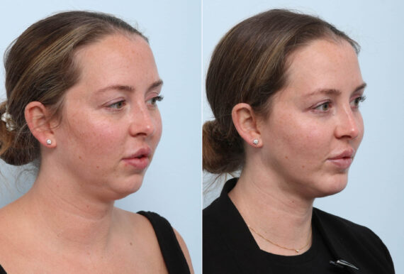 Chin Augmentation before and after photos in Houston, TX, Patient 60304