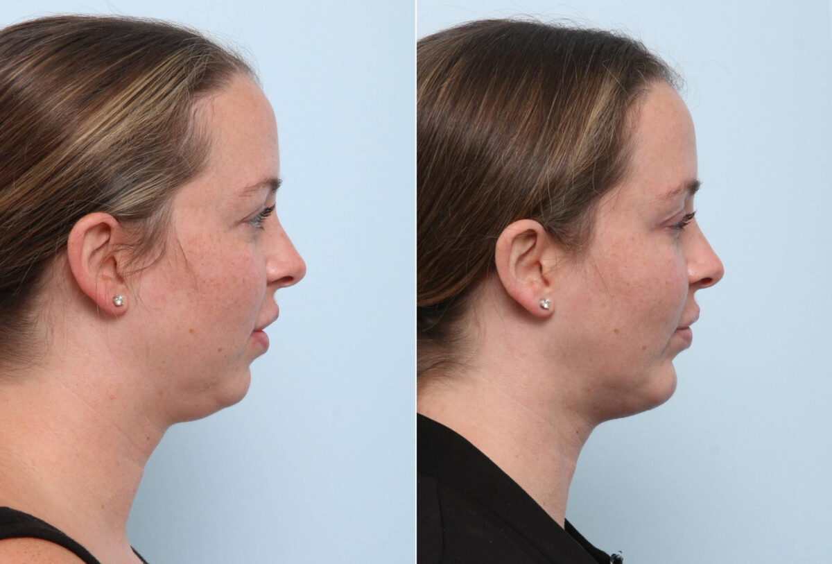 Chin Augmentation before and after photos in Houston, TX, Patient 60304