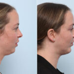 Chin Augmentation before and after photos in Houston, TX, Patient 60304