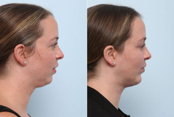 Chin Augmentation before and after photos in Houston, TX, Patient 60304