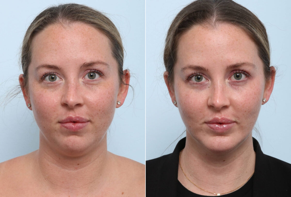 Chin Augmentation before and after photos in Houston, TX, Patient 60304