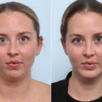 Chin Augmentation before and after photos in Houston, TX, Patient 60304