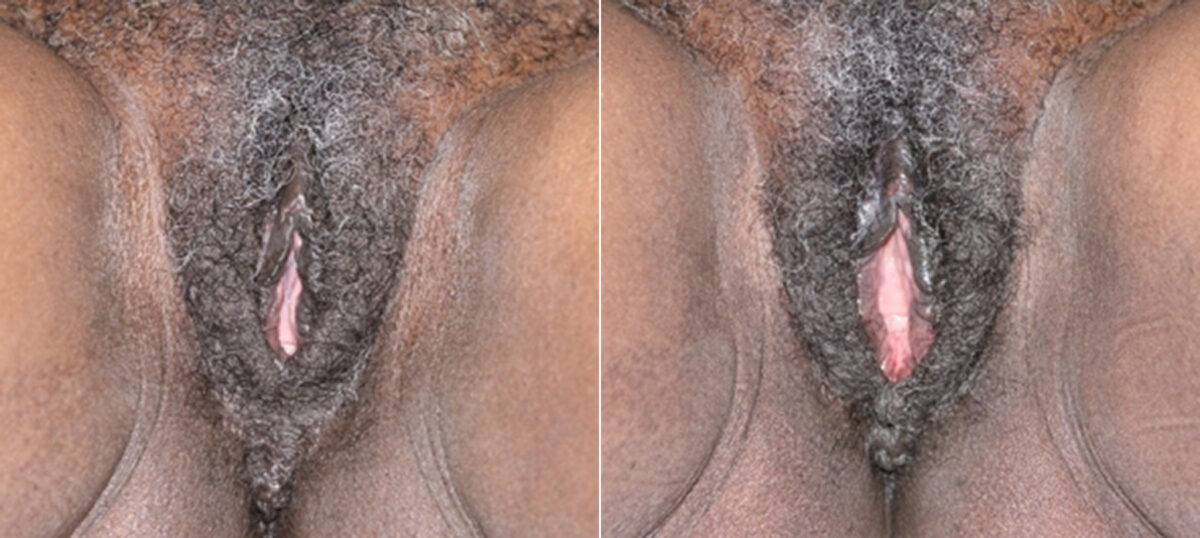Vaginoplasty before and after photos in Houston, TX, Patient 29672
